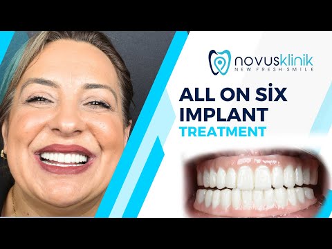 Dental Implants Abroad: Ms. Sümbül’s All-On-Six Journey from the Netherlands
