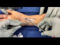 Distal Radius Open Reduction and Internal Fixation