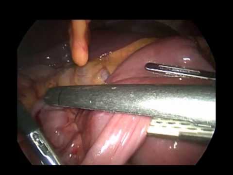 Laparoscopic Segmental Duodenectomy 