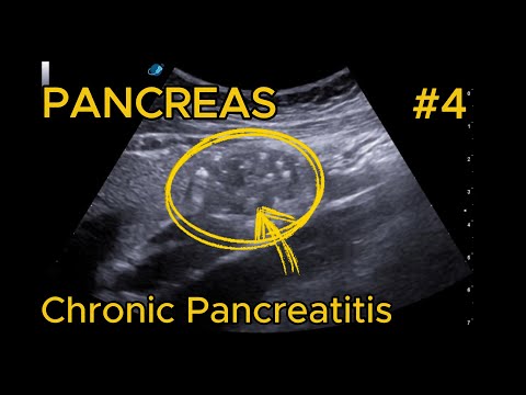 Chronic pancreatitis: Wirsung dilatation and parenchymal calcifications video preview