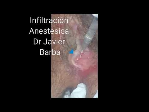 Tratamiento papilomatosis vestibular Papilomatosis genital tratamiento