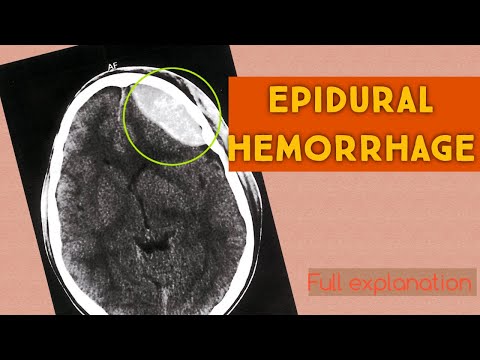 Epidural Hemorrhage Radiology (Epidural Hematoma)