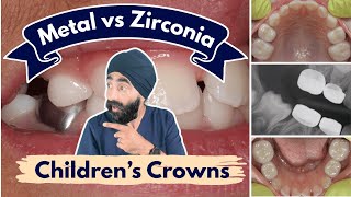 Zirconia vs Metal Hall Crowns vs Conventional with Dr Tim Keys - PDP227