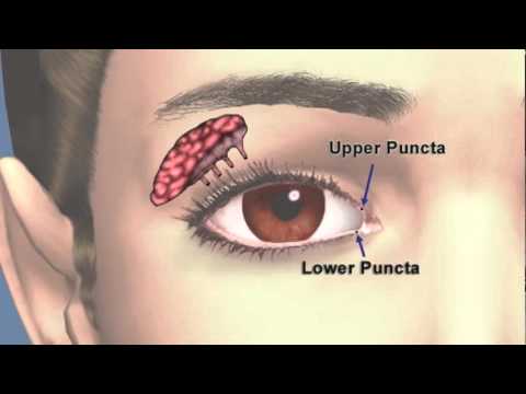 Tear Drainage System