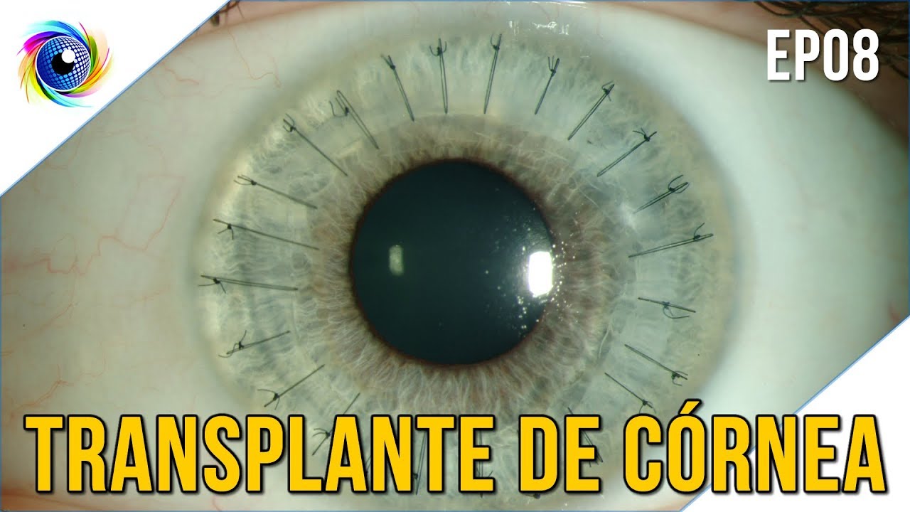 Transplante de córnea para o ceratocone EP 08 - CHECKUP DOS OLHOS