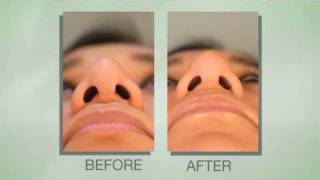 Revision Rhinoplasty Before and After