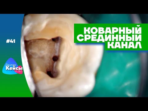 Коварный срединный канал | Дентал Кейсы от BG #41