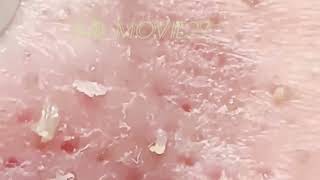 Download Lagu relax,Satisfying,nose blackheads,tweezers,acne treatment,#blackheadremoval #acnetreatment Thumbnail