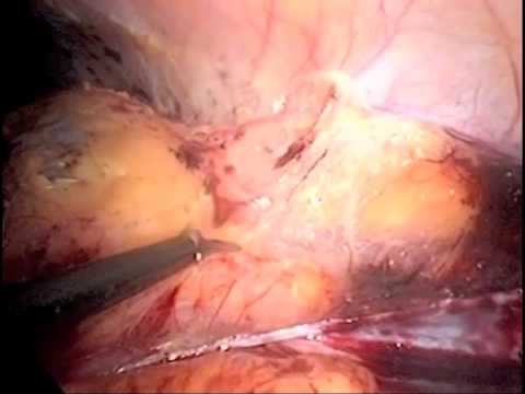 Laparo-Endoscopic Single Site Living Donor Nephrectomy