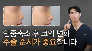 인중축소 후 코의 변화 수술 순서가 중요합니다 | 늑떼선생김현주