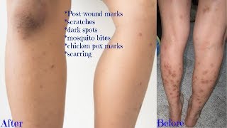 *UPDATED* HOW TO GET RID OF DARK SPOTS ON LEGS & BODY FAST | GET CLEAR EVEN SKIN TONE