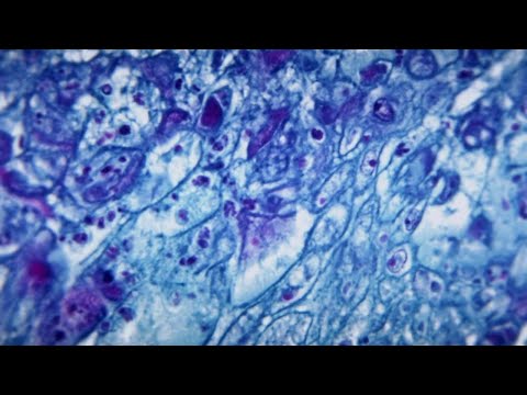 NYC Town Hall Meeting Concerning Monkeypox