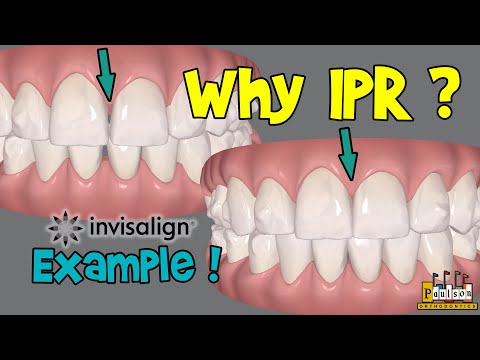 How does IPR or Interproximal Reduction with Invisalign help ! Example Case