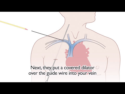 How a tunnelled central line is put in - Cancer Research UK