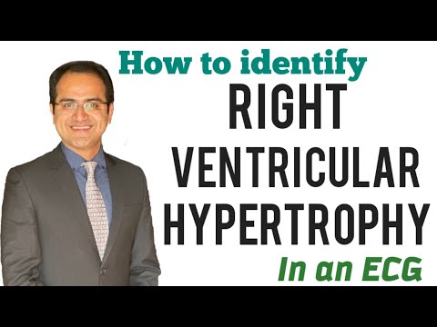 Right Ventricular Hypertrophy (RVH) ECG Explained, ECG Lectures, USMLE, NEET Pg