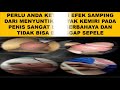 Cara Menghilangkan Bekas Suntik Silikon Minyak Kemiri Dengan Alami Cepat Dan Mudah