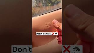 Mosquito bite 5 minutes solution 😍 🦟  no more itchiness or black spots