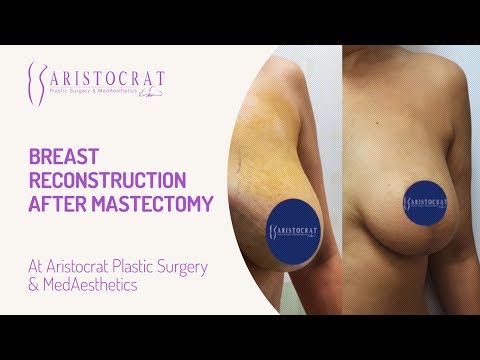 Breast Reconstruction after Mastectomy