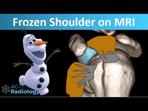 How Frozen shoulder looks on MRI