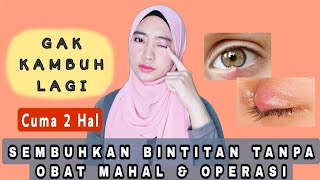 Download lagu Cara Sembuhkan Mata Bintitan secara alami tanpa operasi mp3 Download lagu Cara Sembuhkan Mata Bintitan secara alami tanpa operasi mp3