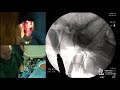 L5 S1 MIS Antero Lateral Approach and Single Position Surgery to Spine  - William D. Smith, MD