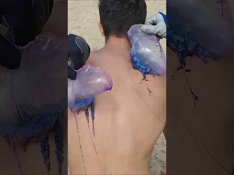 Sting by Man-o-War Jellyfish ! 🪼