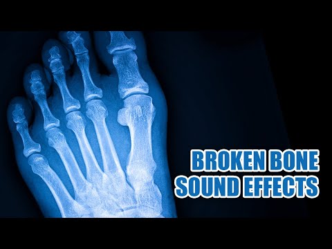 Bone Breaking Sound Effect 🦴 Bone Snapping Sounds