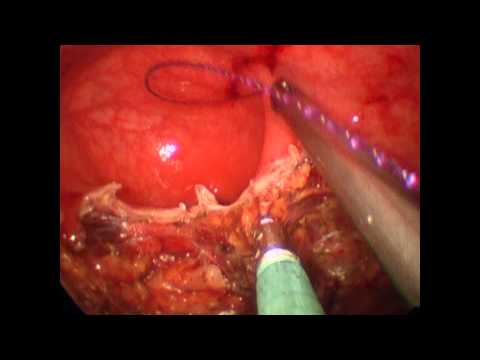 Transanal Minimally Invasive Surgery (TAMIS) For Rectal Polyps and Tumors