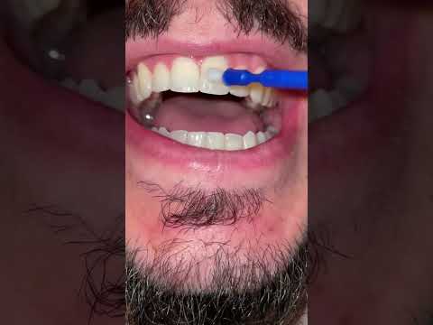 Fluoride varnish for teeth