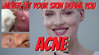 The Ultimate Guide to Acne Types: Tips & Tricks for Banning Them - Part 2