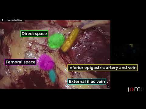 Surgery Steps:Laparoscopic Totally Extraperitoneal (TEP) Left Indirect Inguinal Hernia Repair w/Mesh