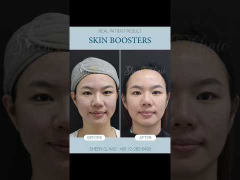 The Secret to Healthy Glowing Skin | Skin Booster Result