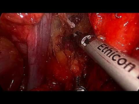 Fibrose im Parenchym der Prostata Ob es möglich ist, Sex zu haben, wenn die männlichen Prostata