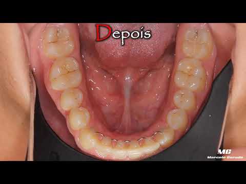 2 - Tratamento Ortodôntico Antes x Depois - Dr. Marcelo Curado