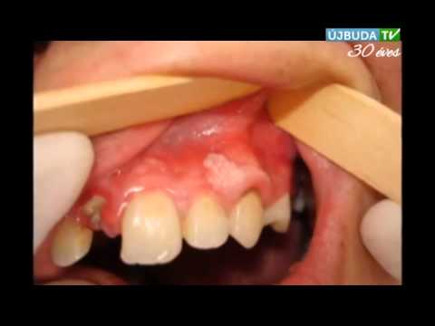 Papilloma vírus szájfertőzés, Mi a HPV-fertőzés?