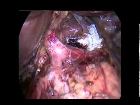 Laparoskopowe radykalne usunięcie pęcherzyka żółciowego i węzłów chłonnych z powodu raka pęcherzyka żółciowego T1b