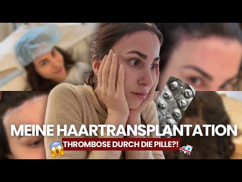 Nicht die Haartransplantation war das Problem … sondern die Pille