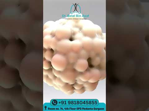 What is Lung Cancer? - Dr. Belal Bin Asaf