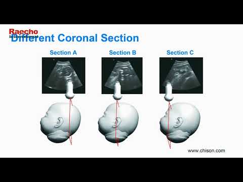 Обзор УЗИ аппарат Chison i3