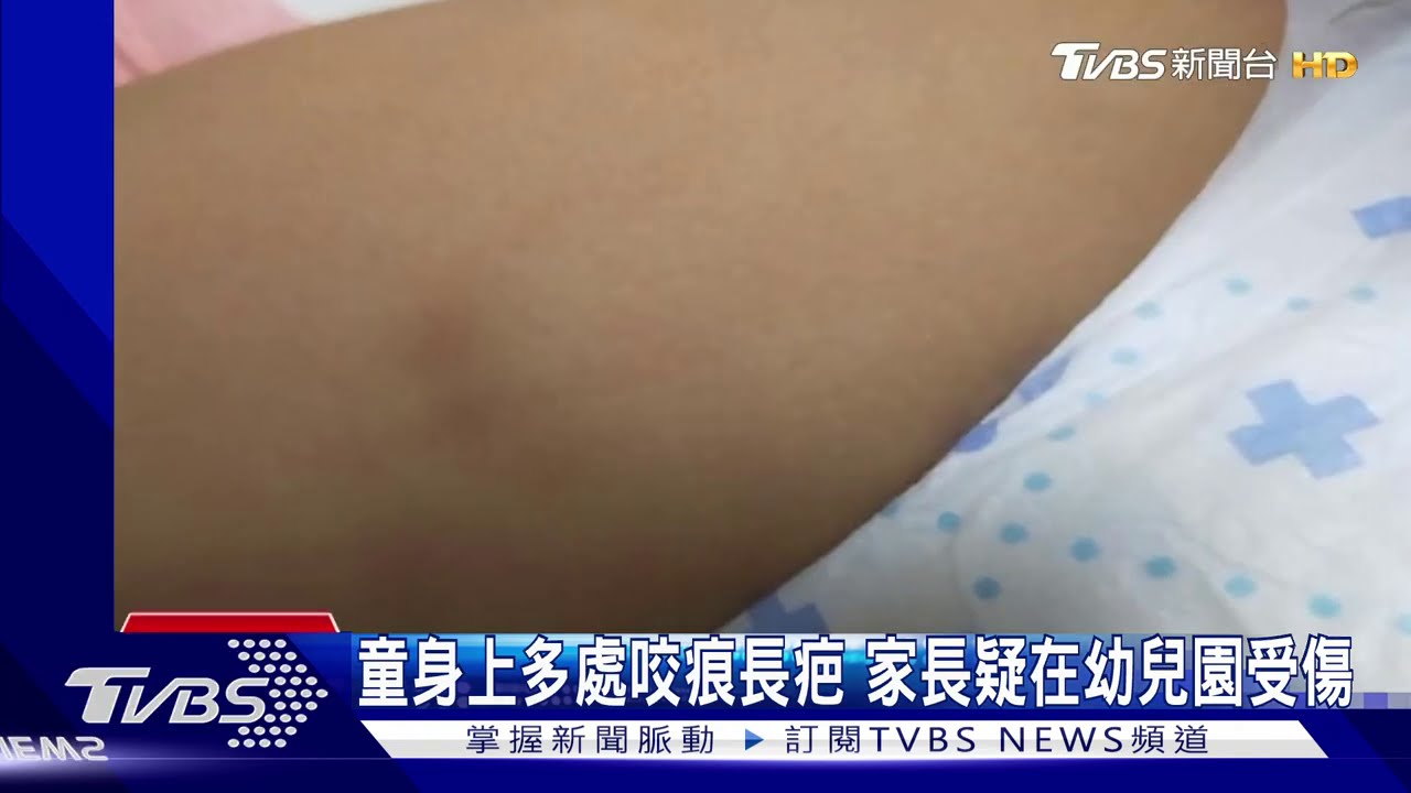 童身上多處咬痕長疤　家長疑在幼兒園受傷