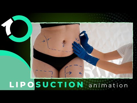 VASER 360 High-Definition Liposuction - Surgical Procedure - One Clinic Patient Review Video