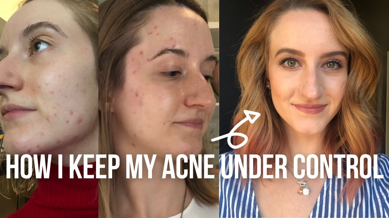 HOW I CLEARED UP MY ACNE | TIPS, TRICKS & WHAT TO ASK YOUR DOCTOR | CLASSICALLY CONTEMPORARY