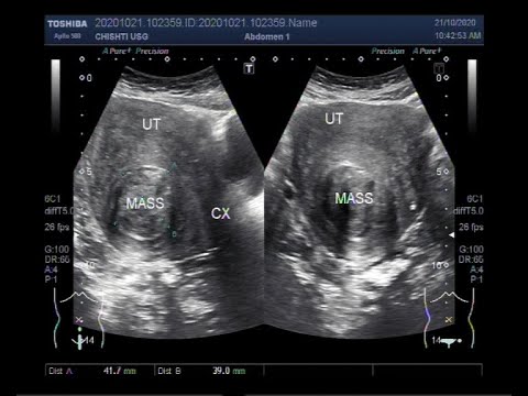 Endometrium rákos szalag, Hpv és tumor