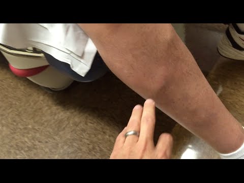 Cele mai eficiente preparate din picioarele varicoase