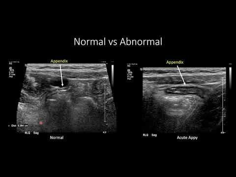 US for Suspected Appendicitis in Children