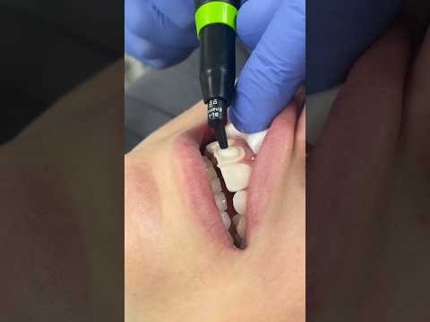 Composite bonding by Dr. Charlie. 👏 #ruhdental #compositebonding