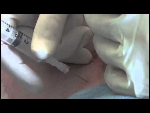 Lumbar Facet Ultrasound Guided Injection - How To