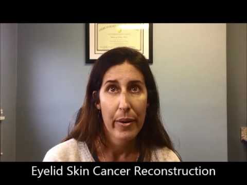 Courtney – Patient Testimonial Eyelid Skin Cancer Reconstructive Surgery Courtney – Patient Testimonial Eyelid Skin Cancer Reconstructive Surgery