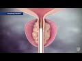 Mayo Clinic Minute: Steam treatment for enlarged prostate