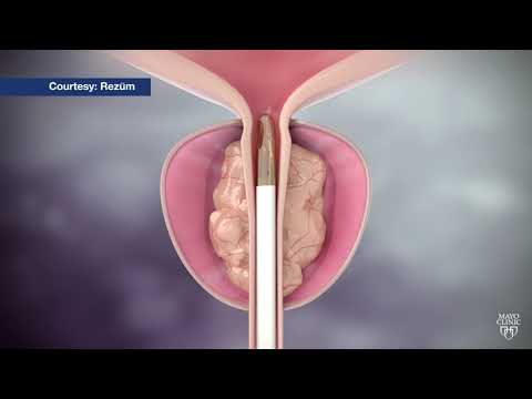 Pleomorphic adenoma treatment of choice